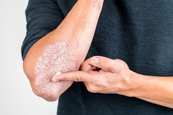 Apply the cream to the area of ​​the skin damaged by psoriasis