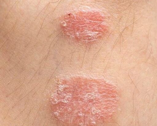 Appearance of psoriatic plates
