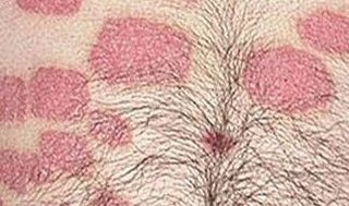More pink formations on the abdomen