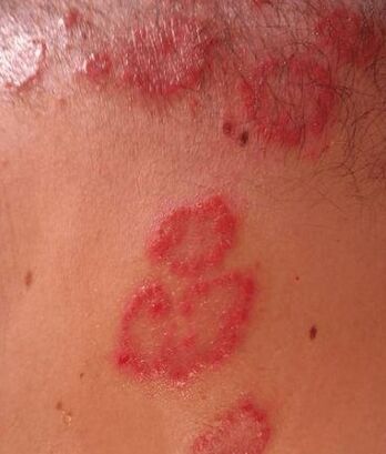 Psoriasis meals