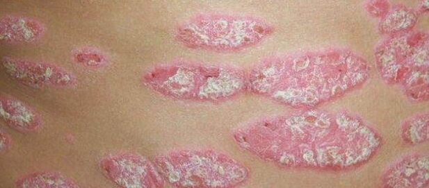 The progressive phase of psoriasis