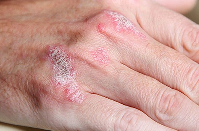 Psoriasis from Ladomaria-Contentuta