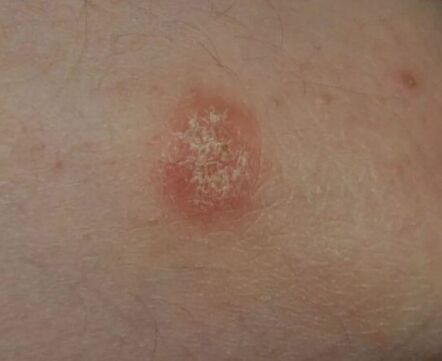 Psoriasis spot