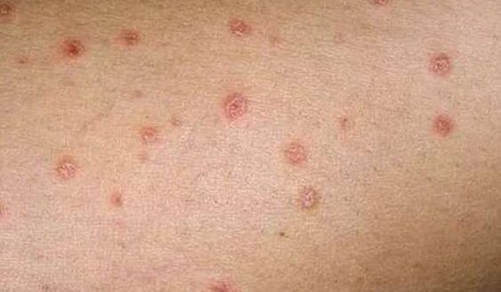 The initial phase of psoriasis