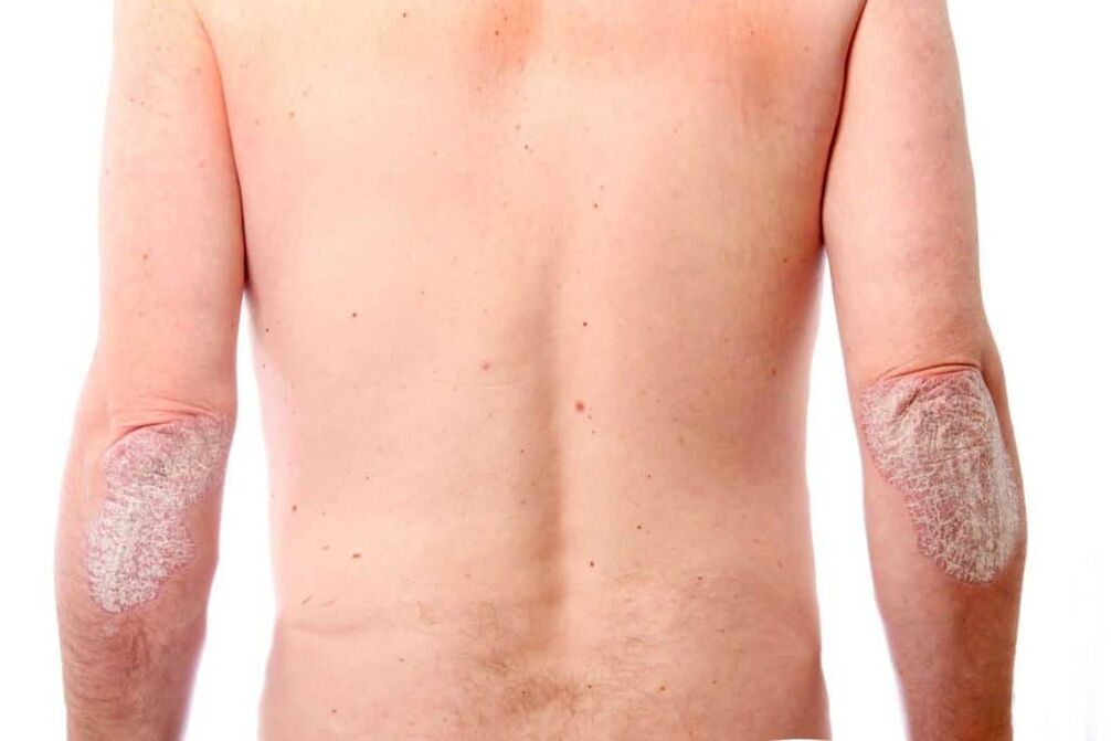 The second phase of psoriasis