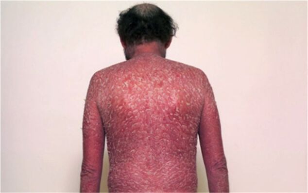 The third phase of psoriasis