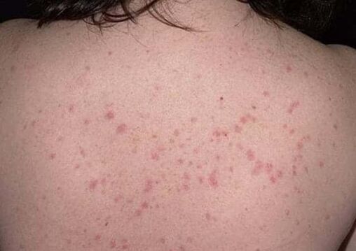 The initial phase of psoriasis