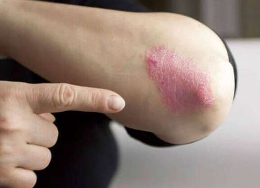 The stationary phase of psoriasis