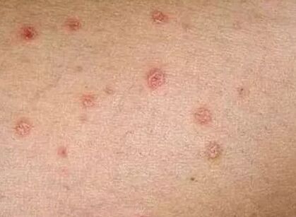 Psoriasis of the initial phase