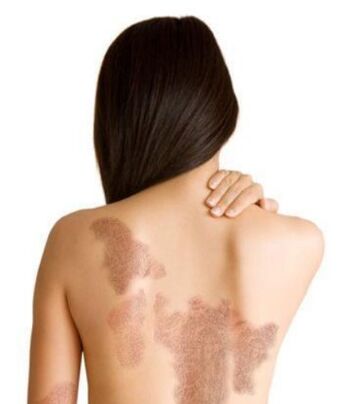Psoriasis phase depending on the injury area
