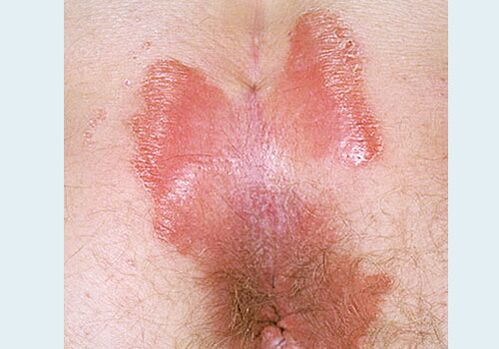Close -Spinning psoriasis