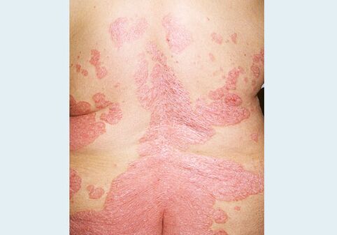 Psoriasis of the rear part