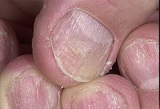 Nail psoriasis