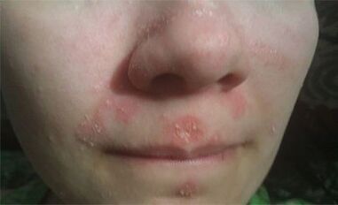 Psoriasis on the face