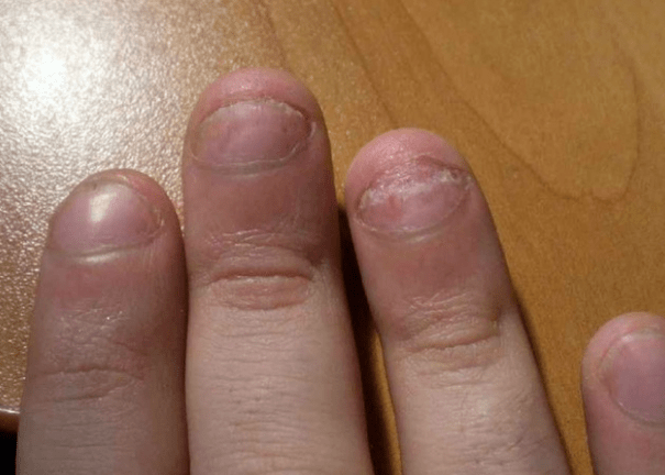Nail psoriasis