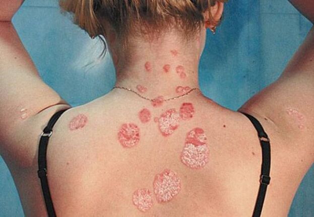 Psoriasis on the back