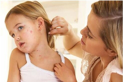 Photos of the initial phase of psoriasis