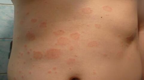 Psoriasis of the initial phase