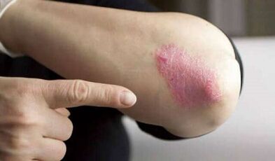 stationary phase of psoriasis development