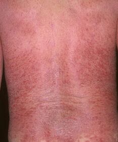 Erythroderma