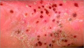 Pustular psoriasis