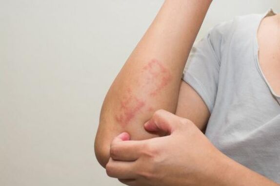 The latest methods for the treatment of psoriasis
