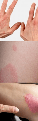 Psoriasis of the initial phase on the hands