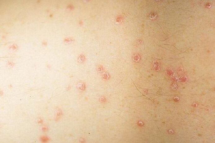 Spot psoriasis symptoms