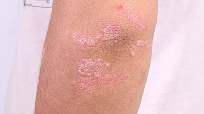 photo of early stage psoriasis