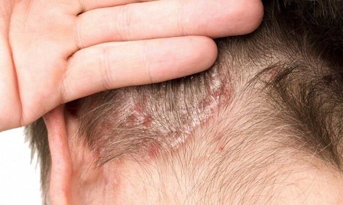psoriasis on the head