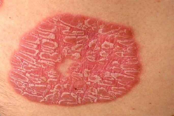 pustular psoriasis