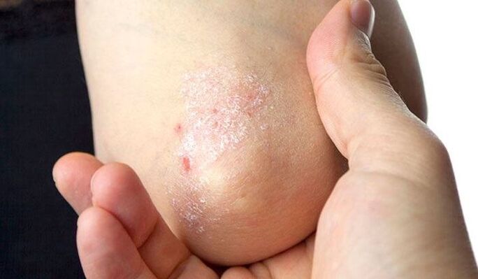 symptoms of psoriasis in the early stage