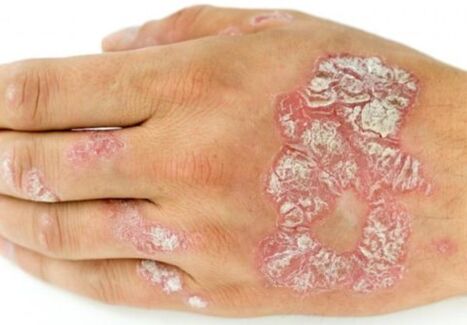 psoriasis at hand