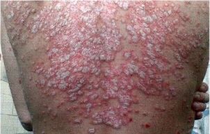 methods of treatment of psoriasis