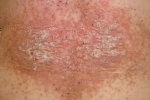 sional stage of psoriasis